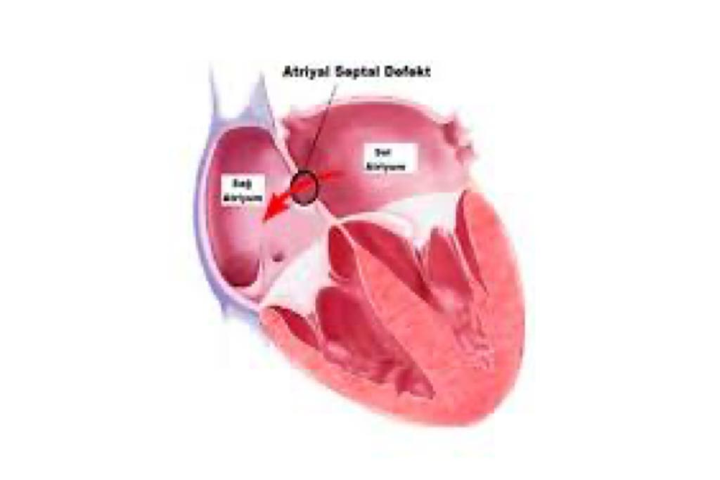 Atrial Septal Defect